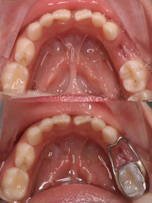正畸真的会导致牙齿过早脱落吗？-图1