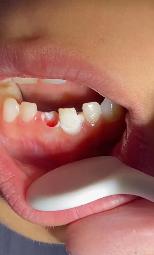 正畸真的会导致牙齿过早脱落吗？-图3