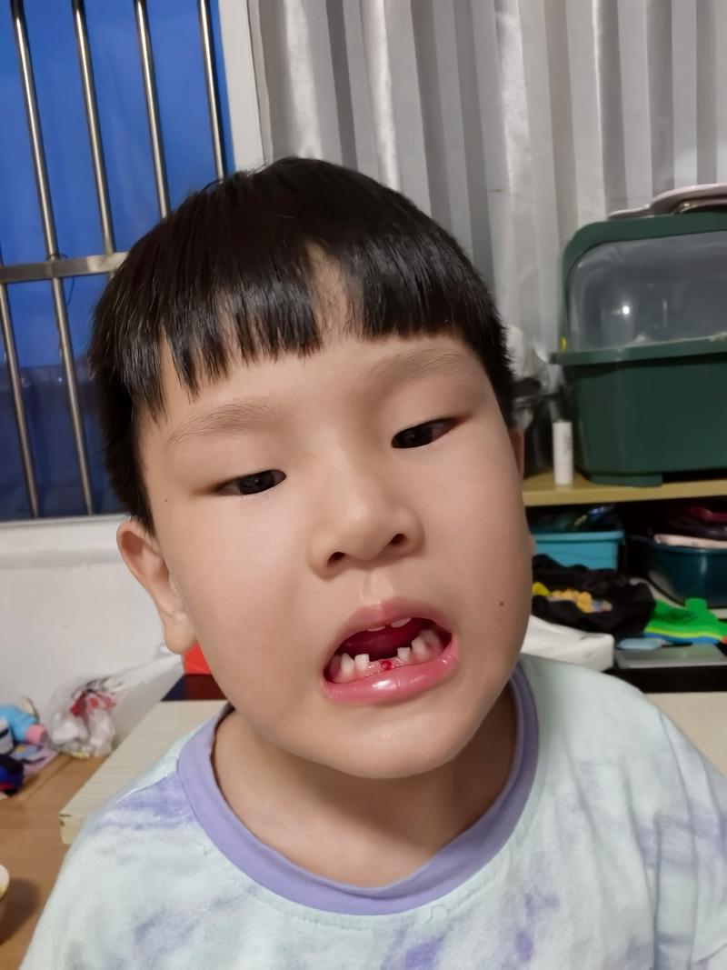 正畸真的会导致牙齿过早脱落吗？-图2