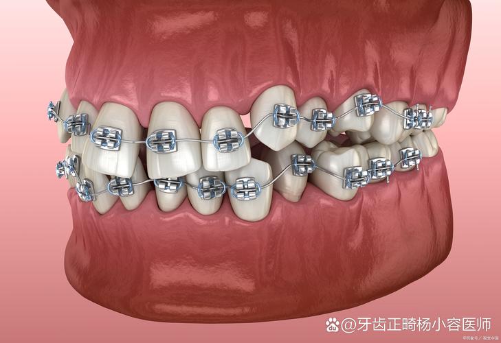 深覆合合并TMD，正畸治疗有效果吗？-图3
