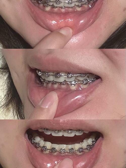 深覆合合并TMD，正畸治疗有效果吗？-图2