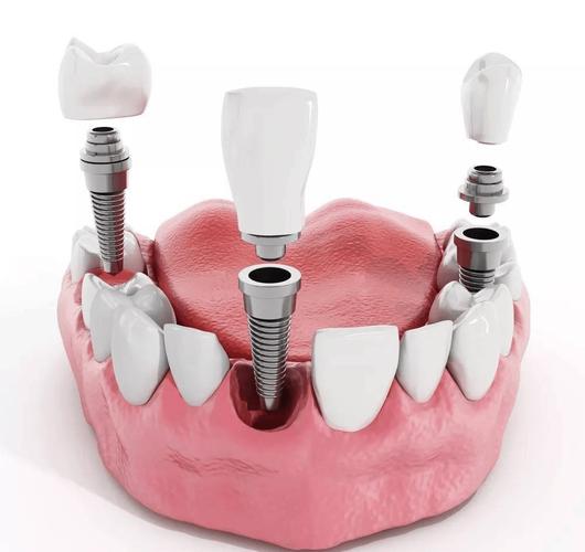 种植体露出来是何原因？该如何处理？-图1