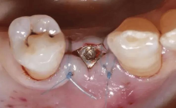 种植体露出来是何原因？该如何处理？-图2