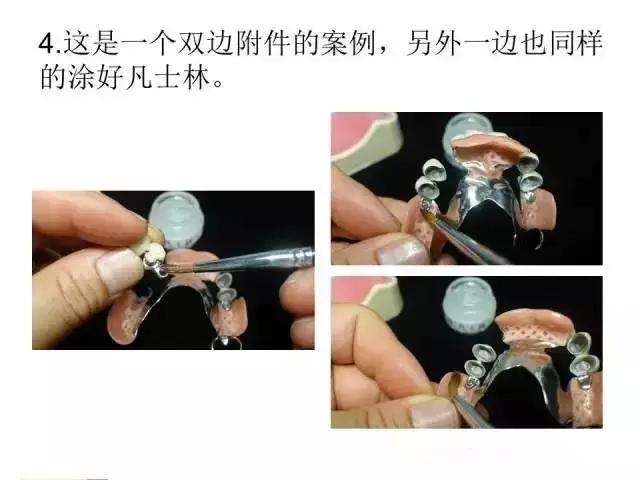 义齿装盒方法的关键步骤及注意事项是什么？-图3