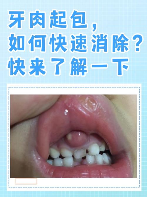 种牙后一定会肿吗-图1