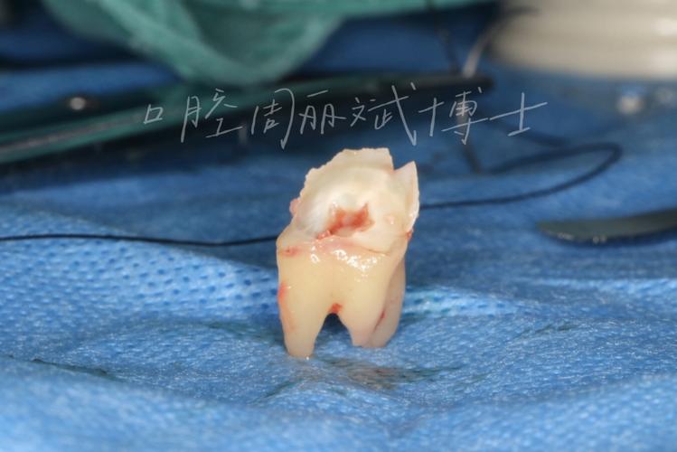 正畸后智齿突然萌出，是巧合还是另有原因？-图2