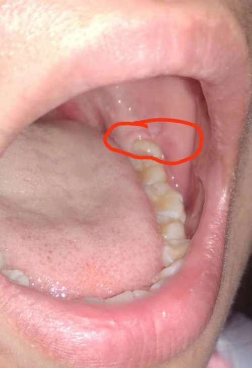 正畸后智齿突然萌出，是巧合还是另有原因？-图1