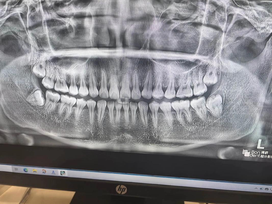 正畸后智齿突然萌出，是巧合还是另有原因？-图3