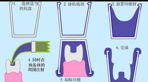 印模的灌注方法-图2