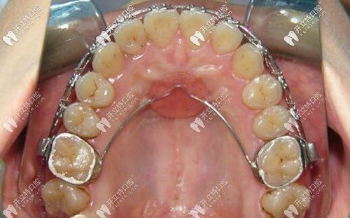 nance弓正畸图片能展示哪些具体矫正细节？-图2