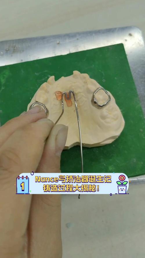 nance弓正畸图片能展示哪些具体矫正细节？-图1