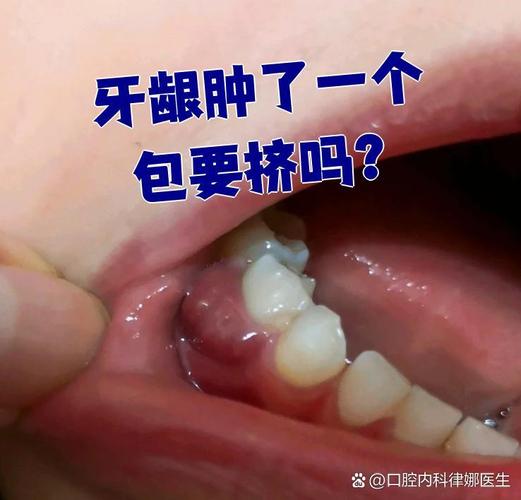 种牙植骨后牙龈肿是什么原因引起的？-图2