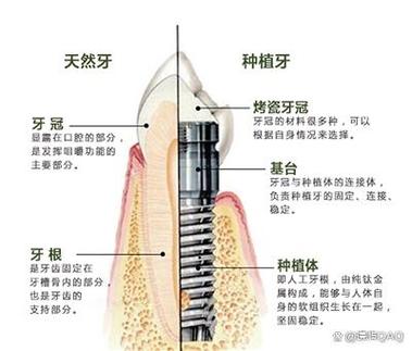 种牙要拔掉牙根吗-图3