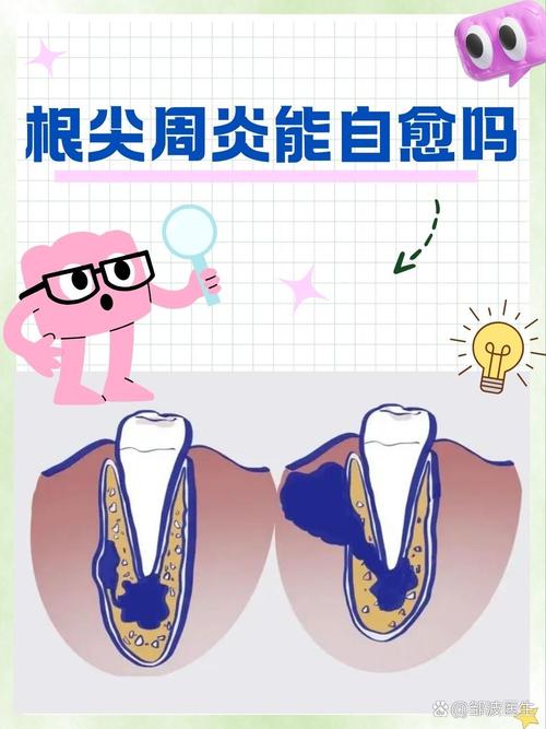 根尖周治疗方法-图3