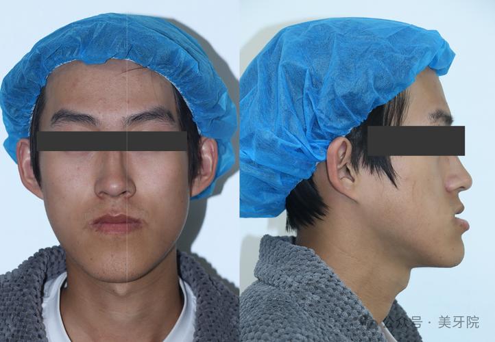 颌干扰治疗方法-图1