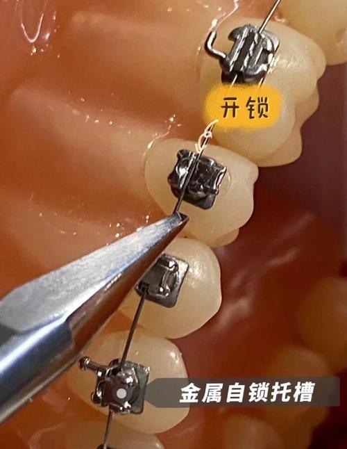 直接粘托槽的具体操作步骤有哪些？-图3