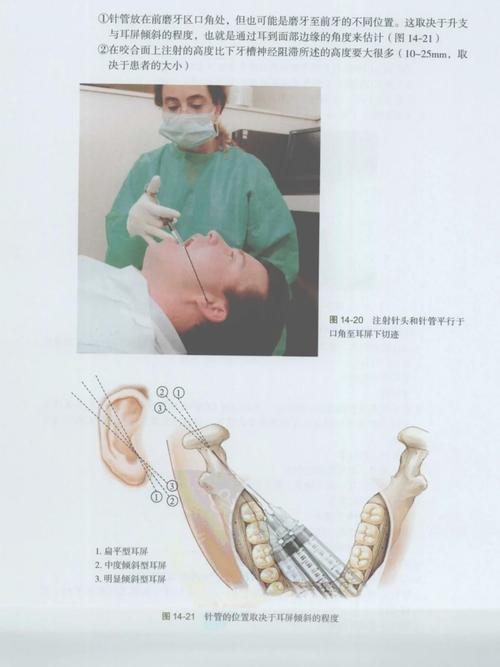 麻醉牙齿的方法有哪些常见类型及适用？-图2