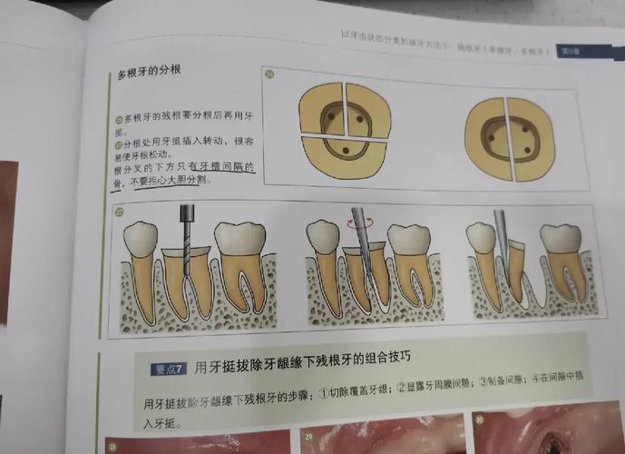 前牙拔除的正确方法有哪些操作要点？-图1