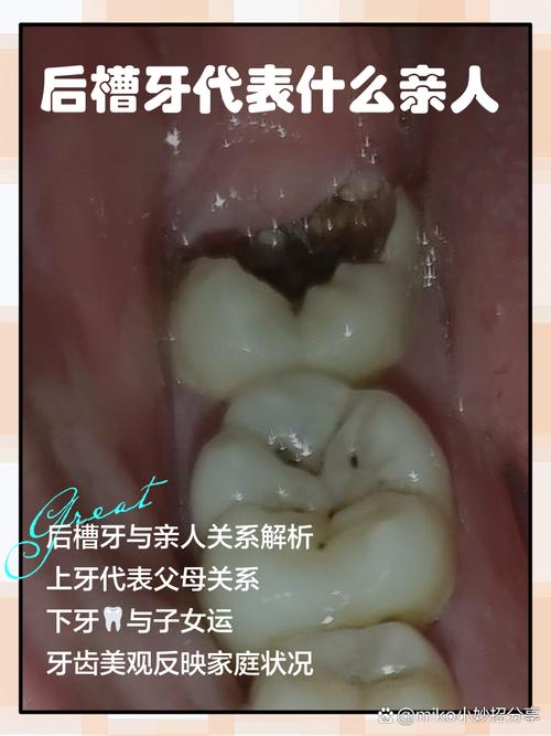 后槽牙种植牙可能存在哪些潜在危害？-图2