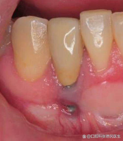 后槽牙种植牙可能存在哪些潜在危害？-图3