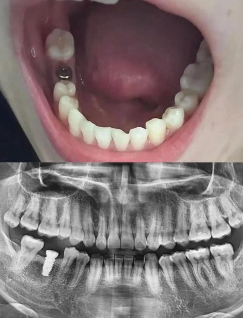 广州种牙那哪里好-图2 广州种牙那哪里好-图2