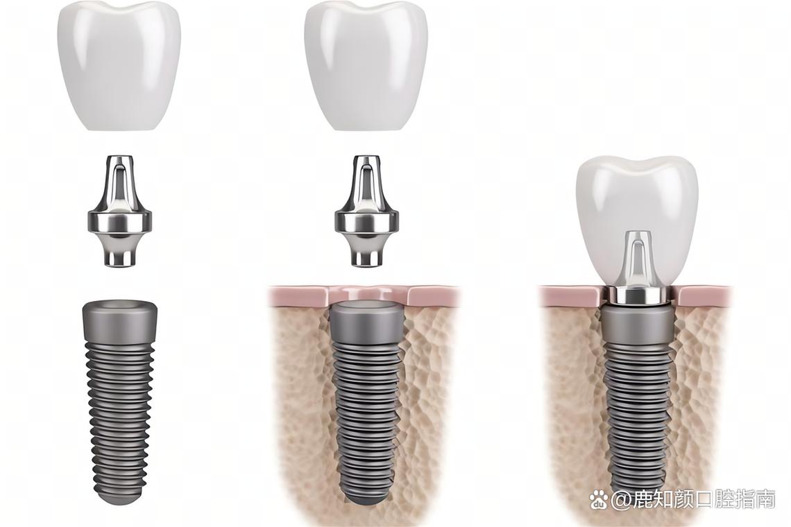 广州种牙那哪里好-图1 广州种牙那哪里好-图1