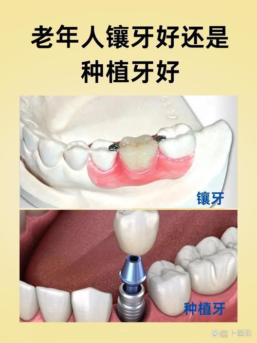 种牙还是活动义齿-图1