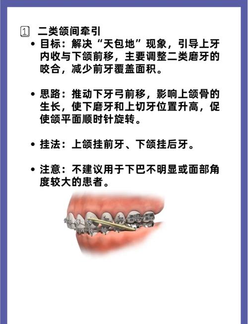 正畸矫治的方法-图3