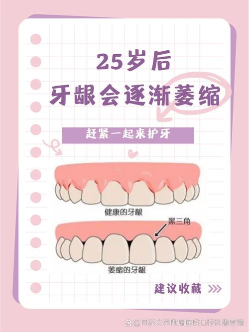 牙龈萎缩可以种牙-图3