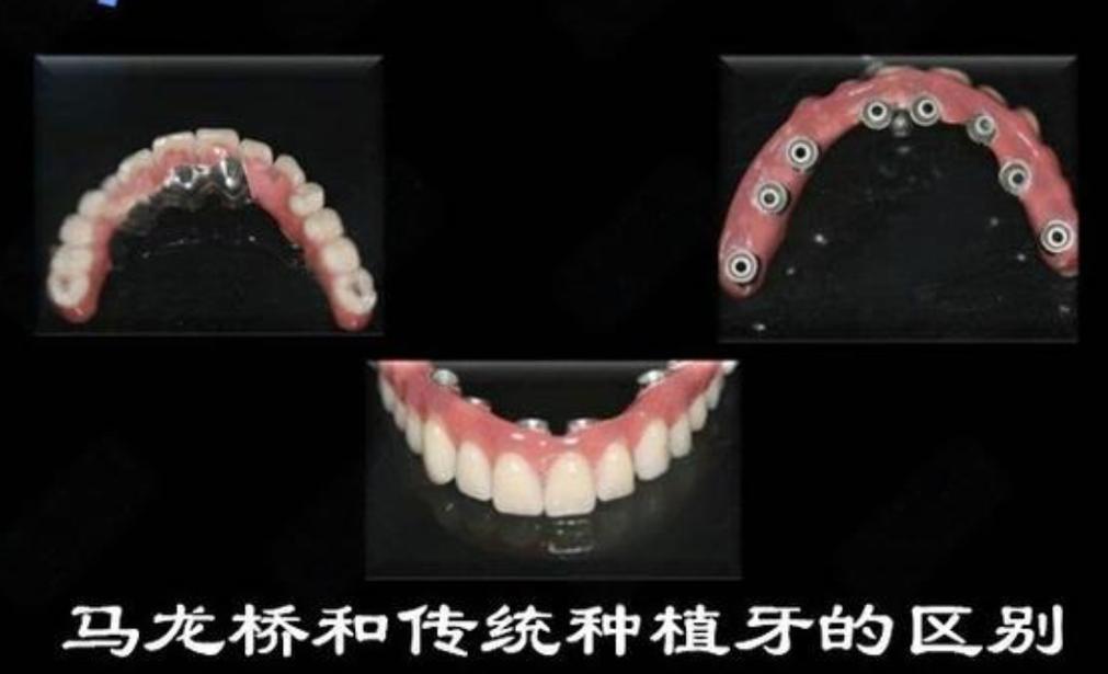 国内种牙哪里最好？医院技术与口碑怎么选？-图1