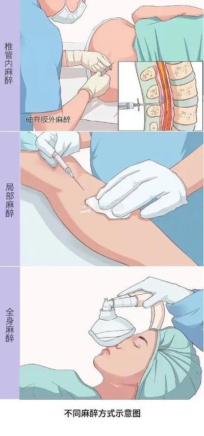 骨膜上麻醉方法-图1