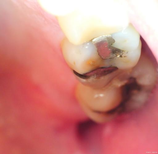 树脂补牙后正畸脱落，是材料影响吗？-图1