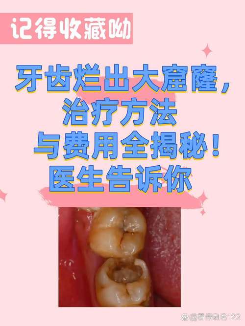 牙齿破损的有效治疗方法有哪些？-图3