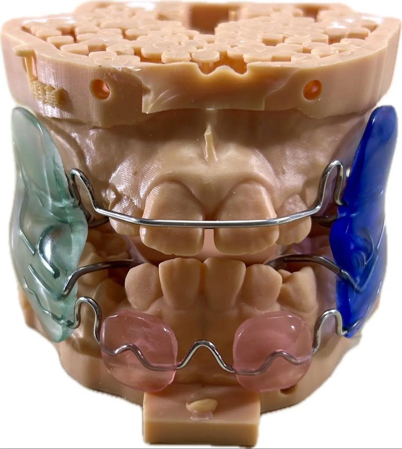 正畸Frank是什么?矫正牙齿的Frank技术是什么?-图1 正畸Frank是什么?矫正牙齿的Frank技术是什么?-图1