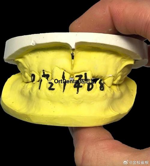 正畸Frank是什么?矫正牙齿的Frank技术是什么?-图3 正畸Frank是什么?矫正牙齿的Frank技术是什么?-图3