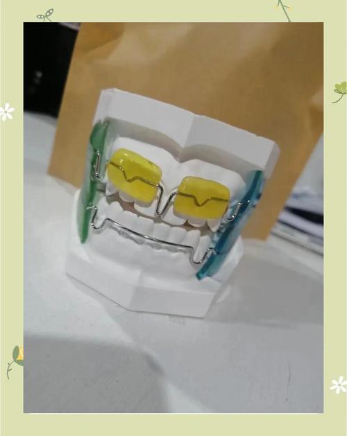 正畸Frank是什么?矫正牙齿的Frank技术是什么?-图2 正畸Frank是什么?矫正牙齿的Frank技术是什么?-图2