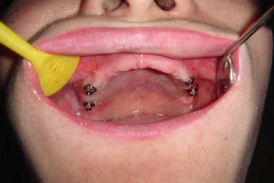 没有真牙的情况下，是否还能进行种植牙治疗呢？-图2