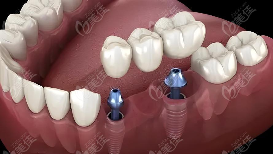 种牙美国3i植体-图3 种牙美国3i植体-图3