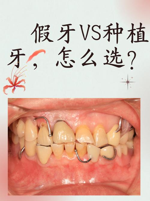 镶牙和种牙一样吗-图3