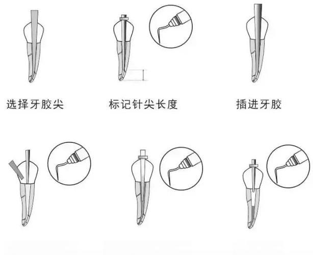 牙胶尖充填方法的关键步骤有哪些？-图1