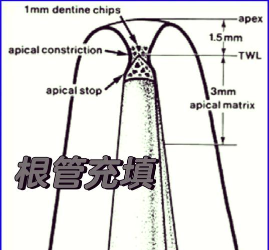 牙胶尖充填方法的关键步骤有哪些？-图2