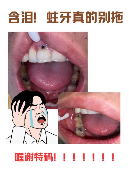 蛀牙洞土方法真的能修复吗？安全吗？-图3