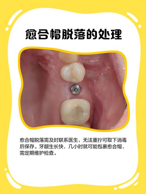 种牙愈合帽是什么？种植牙过程必备吗？-图1