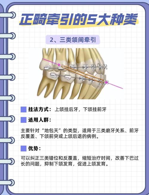 口腔正畸正畸二类骨性-图3 口腔正畸正畸二类骨性-图3