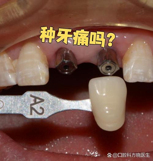 种牙需要打麻药吗?手术过程会有疼痛感吗?-图1 种牙需要打麻药吗?手术过程会有疼痛感吗?-图1