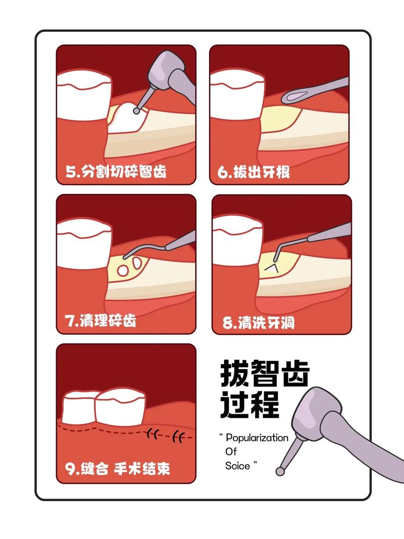 拔牙新技术，如何让拔牙更轻松、恢复更快？-图3