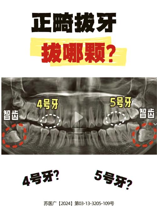 拔牙正畸vs不拔牙正畸，如何抉择更合适？-图3