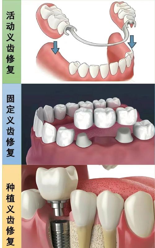 快速镶牙的方法可靠吗？效果和安全性如何？-图2