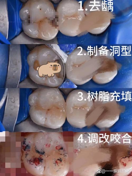 补固定假牙方法-图3