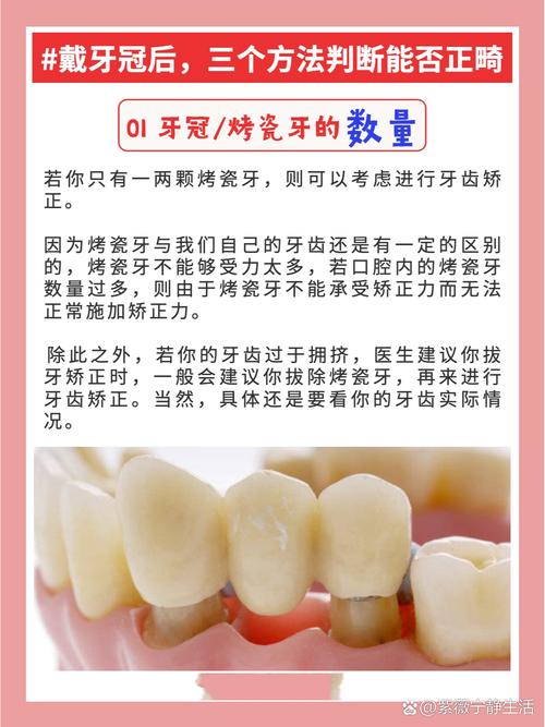 做烤瓷牙好还是正畸好-图3